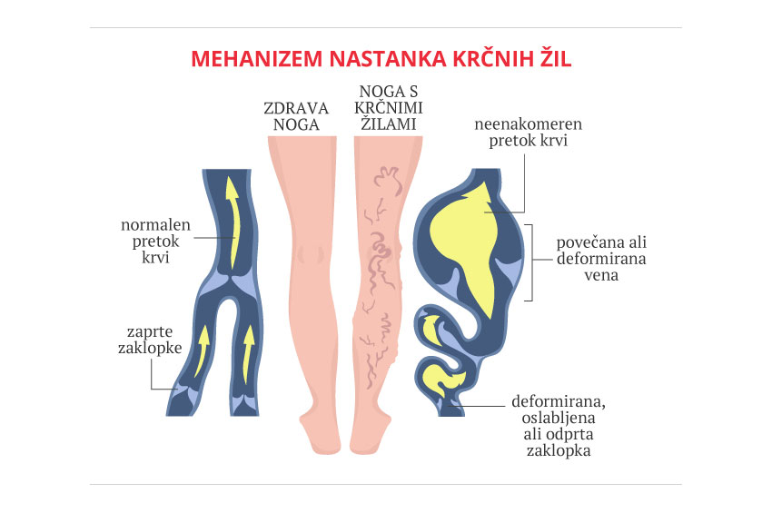 nastanek krčnih žil