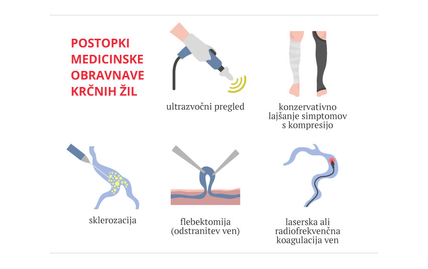 medicinsko-zdravljenje-krcnih-zil